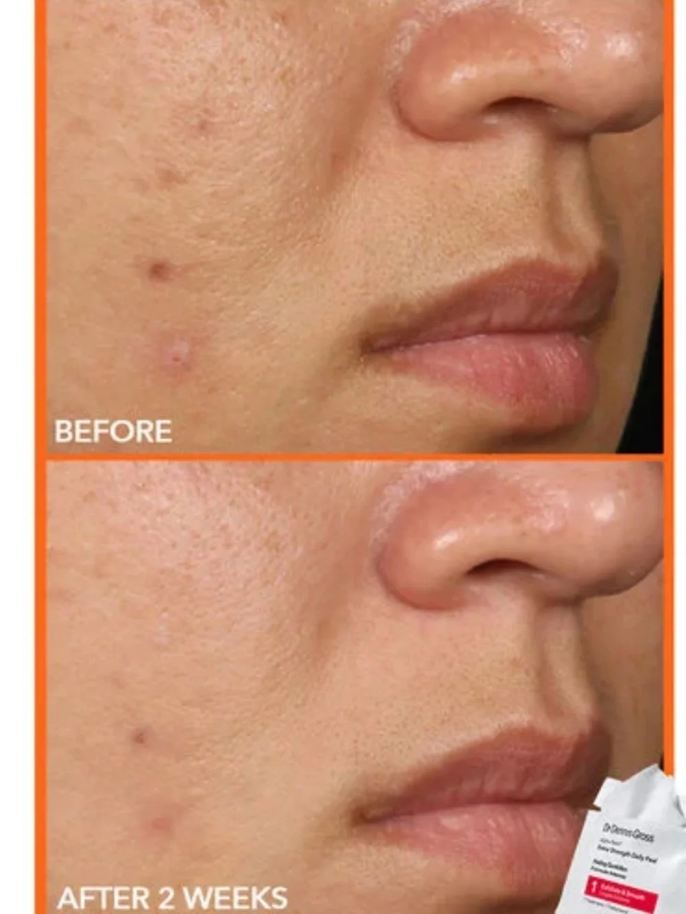 Dr. Dennis Gross Alpha Beta® Extra Strength Daily Peel